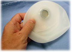 Image: tissue expander. The access port is visible; this is the point that is accessed (through the skin) to fill the expander with saline during the expansion process.