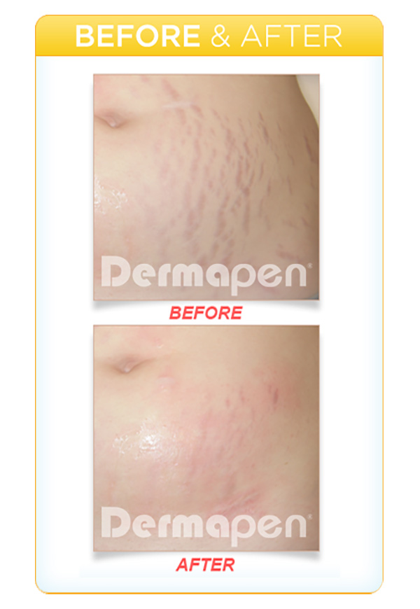Before and after results of Dermapen treatment on Stretch Marks