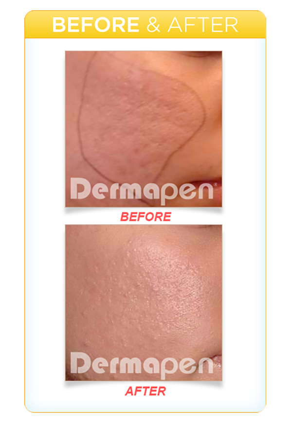 Before and after results of Dermapen treatment on Acne Scars