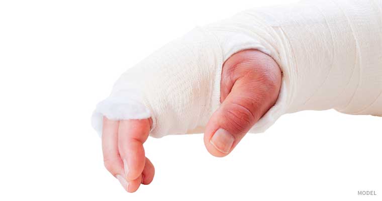 Person's hand in a cast