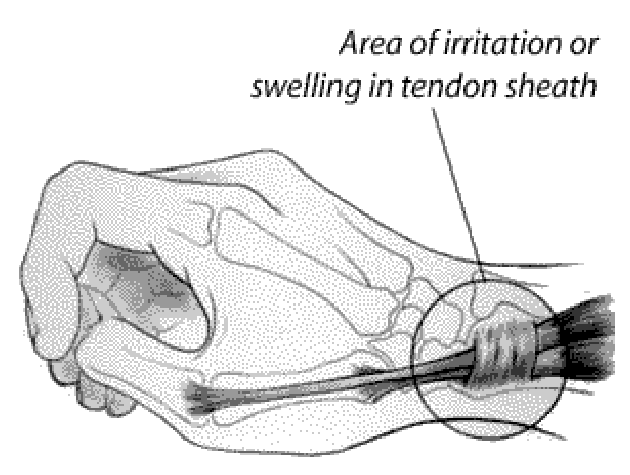 Diagram: Area of irritation or swelling in tendon sheath