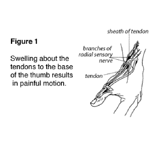 Figure 1: Swelling about the tendons to the base of the thumb results in painful motion
