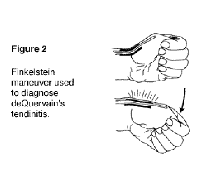 Figure 2: Finkelstein maneuver used to diagnose deQuervain's tendinitis