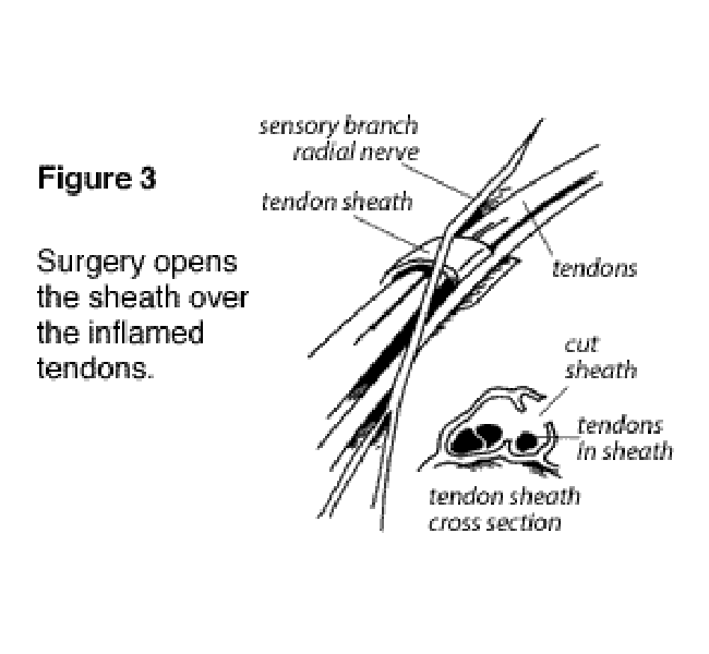 Figure 3: Surgery opens the sheath over the inflamed tendons