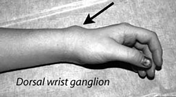 Illustration: Dorsal wrist ganglion, top of the wrist