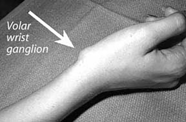 Illustration: Volar wrist ganglion, side of the wrist