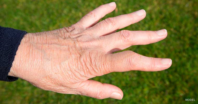 Shape of hand with boutonnière deformity