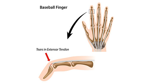 Diagram: skeletal illustration of Baseball finger