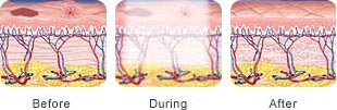 Before, During, and After illustration of skin treatment