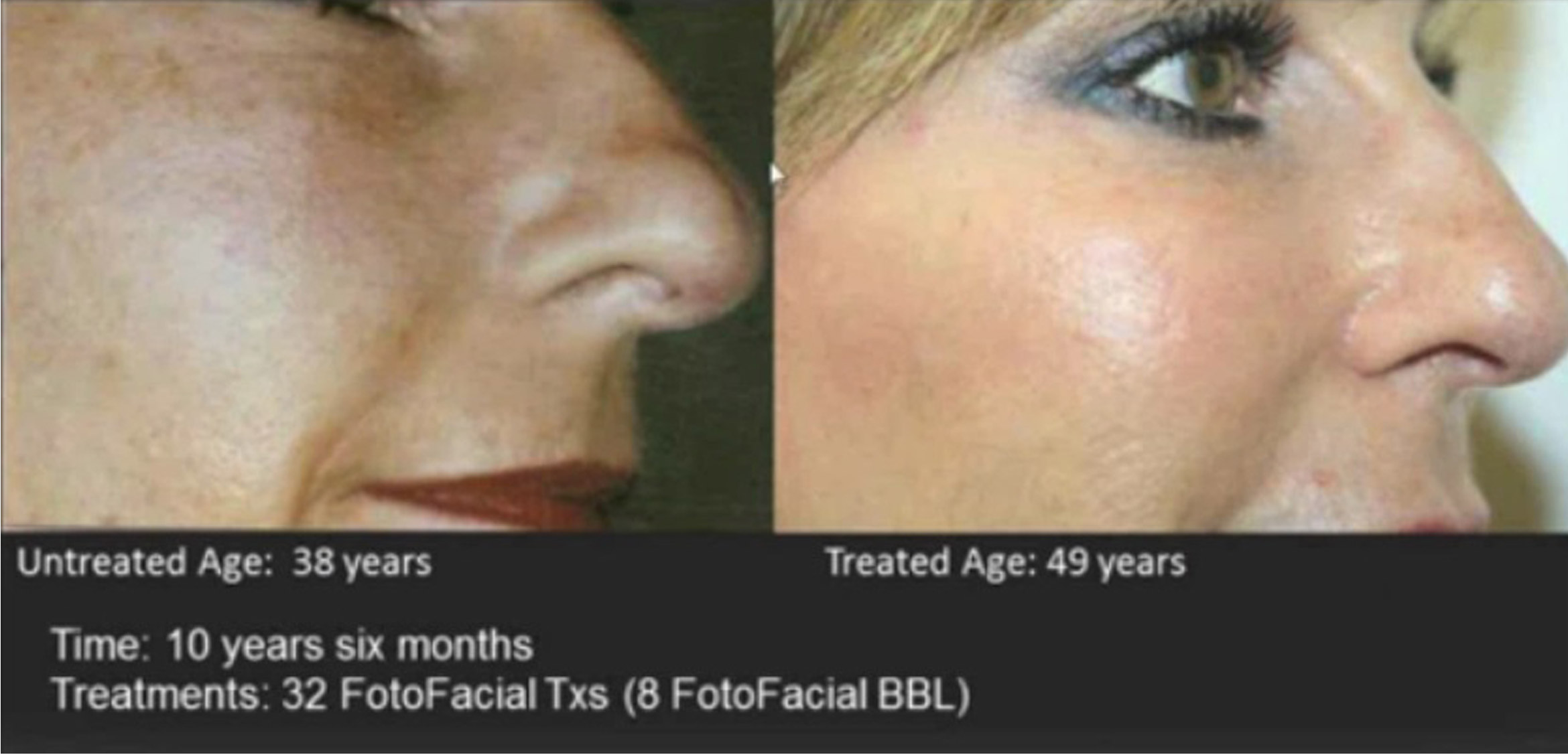 BBL Face before & After Treatment