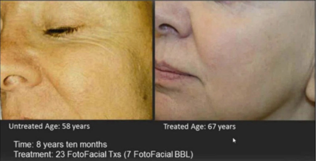 23 FotoFacial Txs