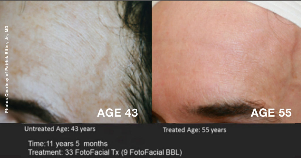 33 FotoFacial Tx