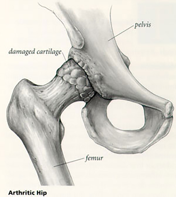 Illustration - Arthritic Hip: Pelvis, damaged cartilage on ball of femur, socket of pelvis