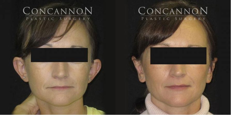 Concannon Plastic Surgery Patient: Before and After Ear Surgery