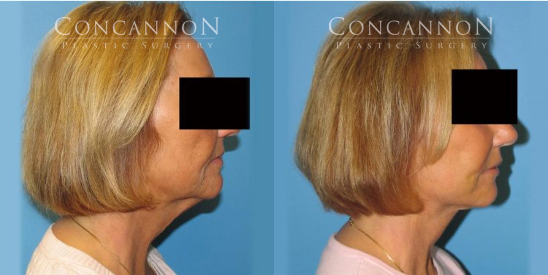 Before and After Facelift Procedure