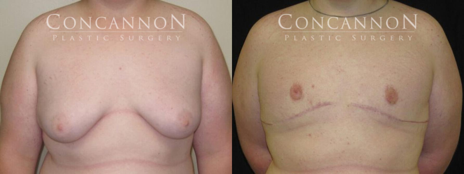 Before and After Photo - Gynecomastia Surgery