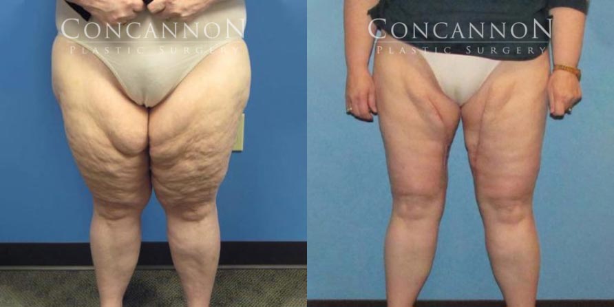 Concannon Plastic Surgery – Thigh Lift - Columbia, MO