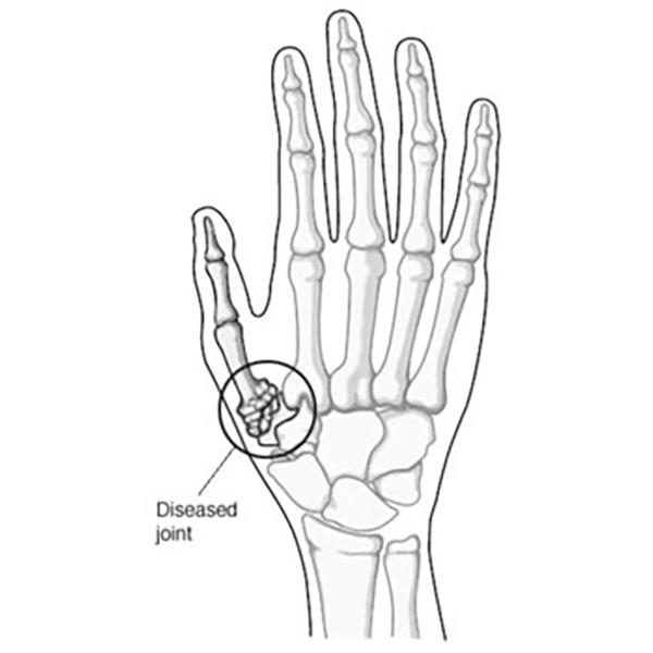 Diagram: hand with diseased joint