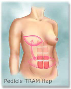 Pedicle TRAM Flap