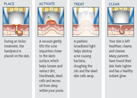 Isolaz Acne Therapy treatment steps: Place, Activate, Treat, Clear