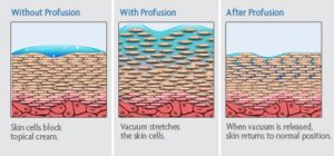 Diagram: How Profusion Skin Therapy Works