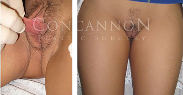 Labiaplasty Actual Patient Before and After Results