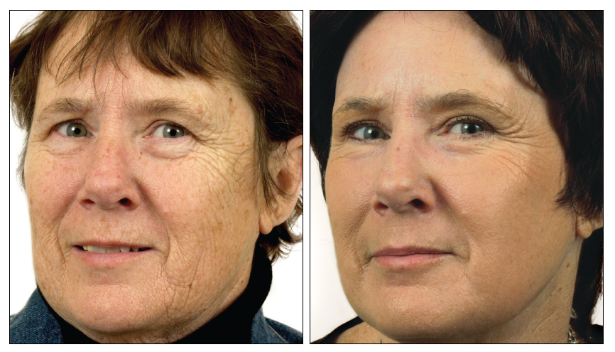 Before and After Results for Skin Resurfacing