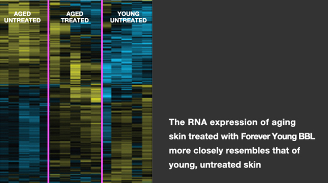 The RNA expression of aging skin treated with Forever Young BBL more closely resembles that of a young, untreated skin