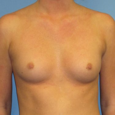 Breast Augmentation Before Patient 30