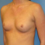 Breast Augmentation Before Patient Thumbnail 2