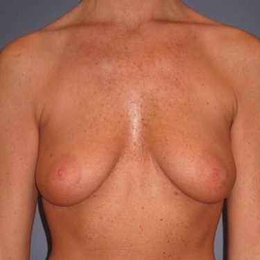 Dual-plane technique Before Patient 6