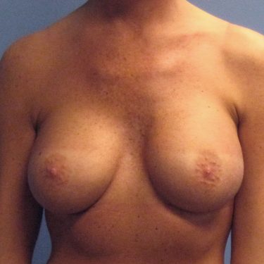 Dual-plane technique After Patient 6