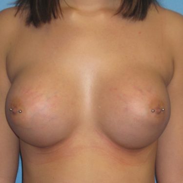 Dual-plane technique After Patient 5