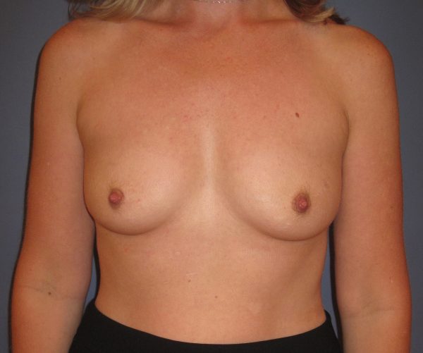 Breast Augmentation Before Patient 1