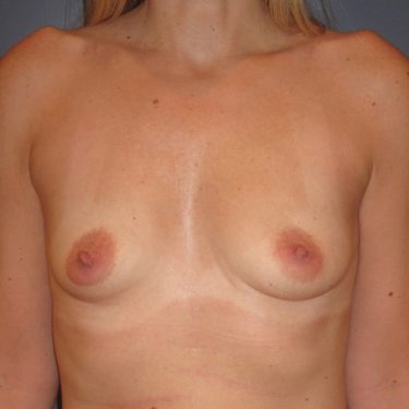 Breast Augmentation Before Patient 25