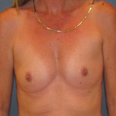 Breast Augmentation Before Patient 24