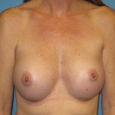 Breast Augmentation After Patient 24