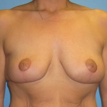 Breast Lift After Patient 16
