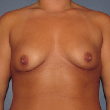 Dual-plane technique Before Patient 4