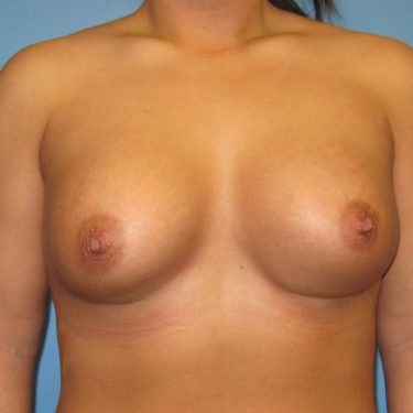 Dual-plane technique After Patient 4