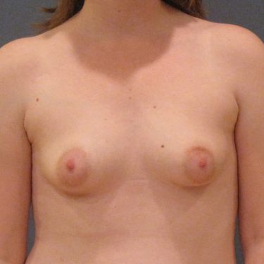 Dual-plane technique Before Patient 2