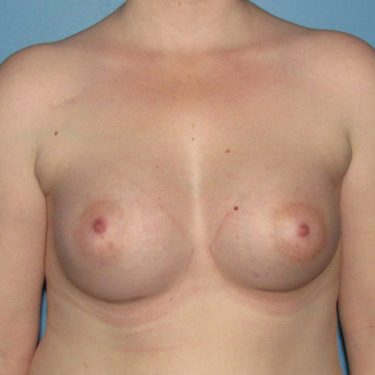 Dual-plane technique After Patient 2