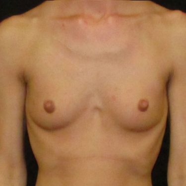 Breast Augmentation Before Patient 20