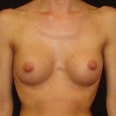Breast Augmentation After Patient 20