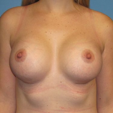 Dual-plane technique After Patient 1