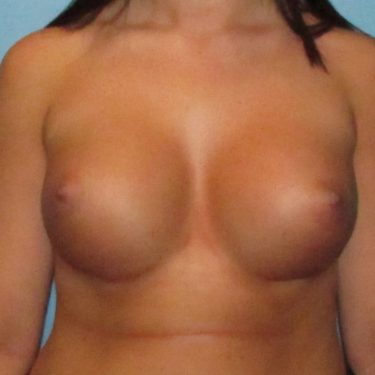 Dual-plane technique After Patient 30