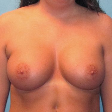 Breast Augmentation After Patient 17