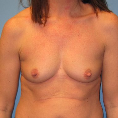 Breast Augmentation Before Patient 16