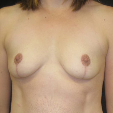 Breast Lift After Patient 8
