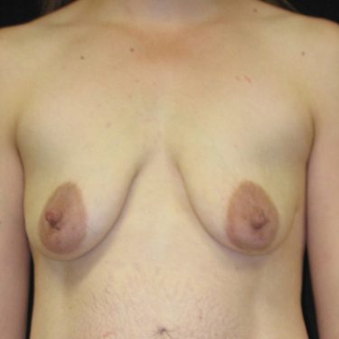 Breast Augmentation with Lift Before Patient 16